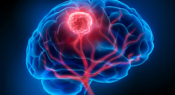 Brain tumor treatment